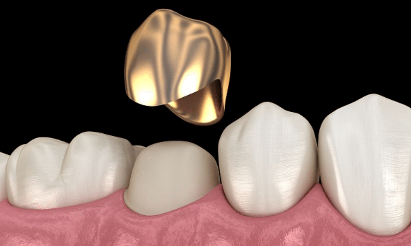 What Is A Dental Crown & What Is The Procedure To Get It?