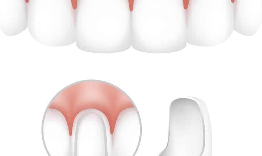 How Often Do Dental Crowns Fall Out?