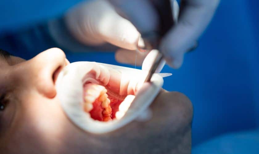 How Long Do Dental Sealants Last? Exploring Their Lifespan And Maintenance