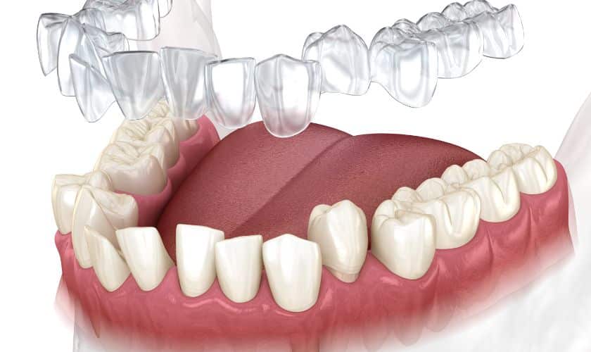 Invisible Braces, Visible Results: Invisalign in Phoenix