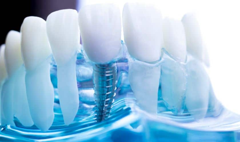 Dental Implants in Phoenix