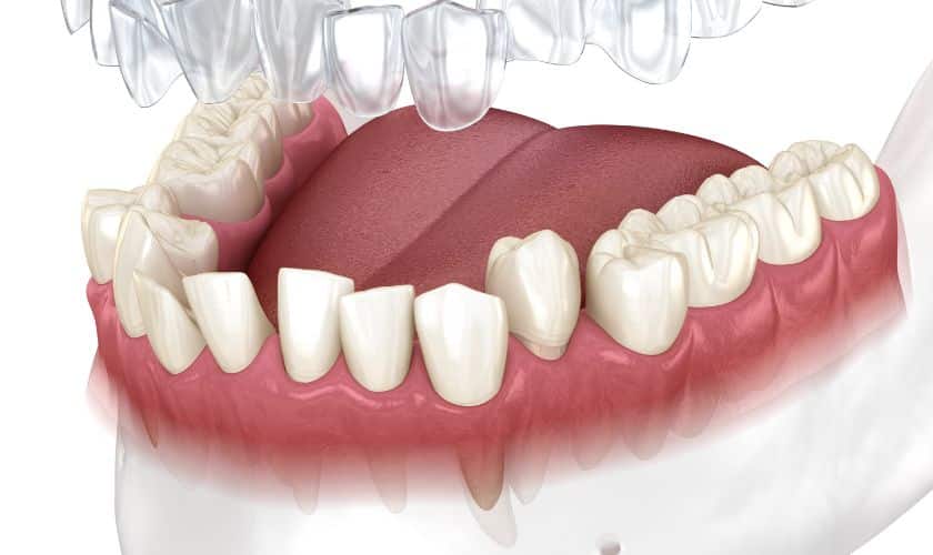 How Long Does Invisalign Take to Fix an Underbite?