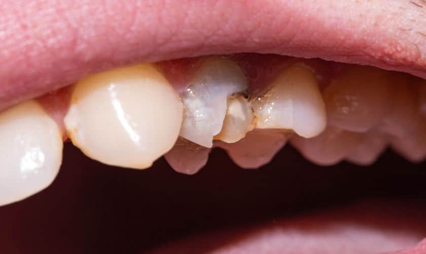 How Do Cosmetic Dentists Fix Small Chips in Teeth?