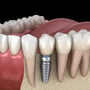 bcr dentistry phoenix az services dental implants image