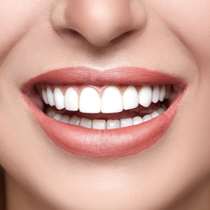 Teeth Whitening